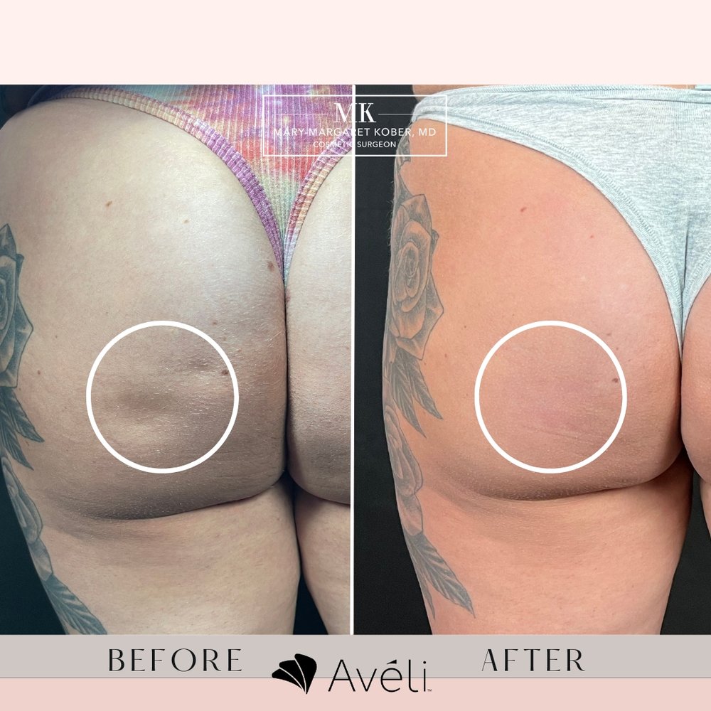 Before and After Aveli cellulite treatment in Denver, Colorado