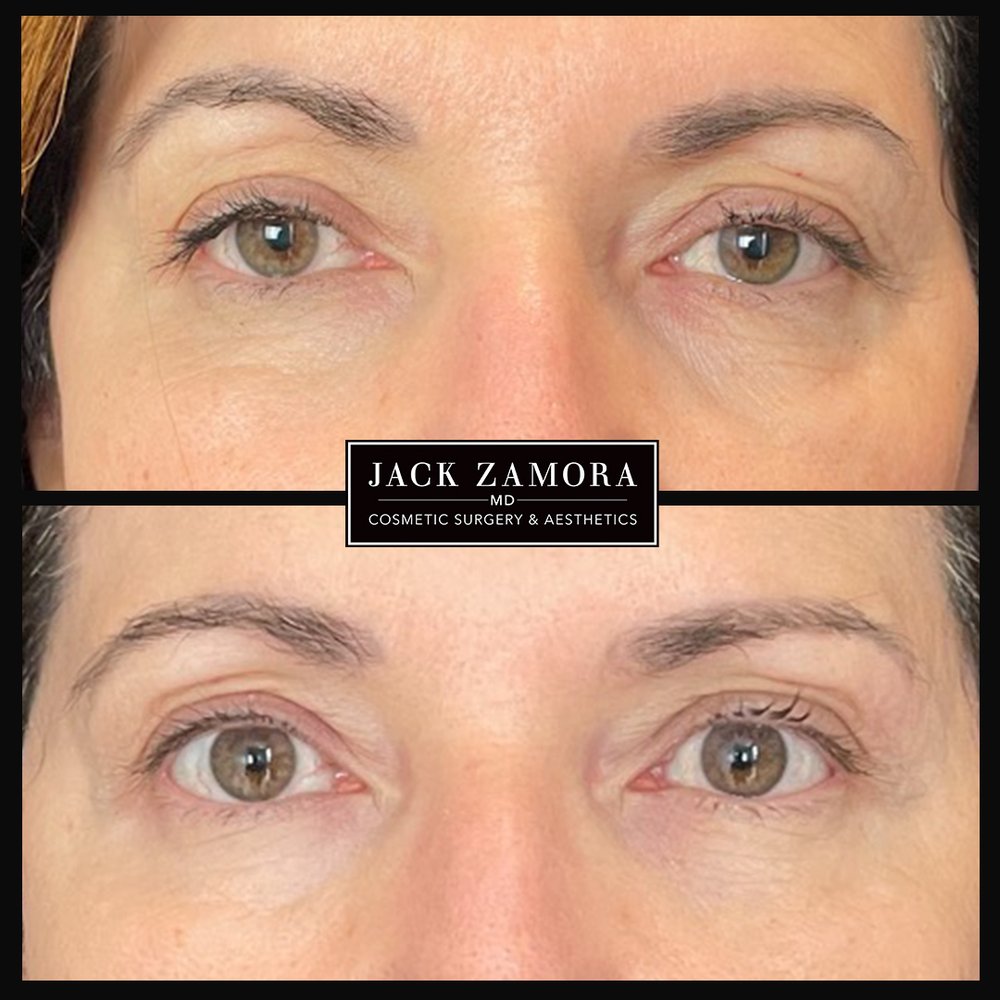 ATTIVA Upper Eyelid Lift