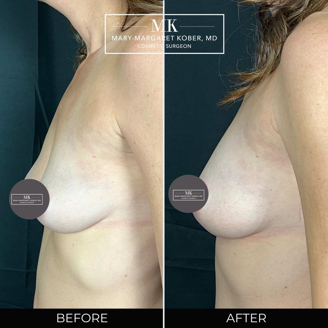 Fat Transfer to the Breast