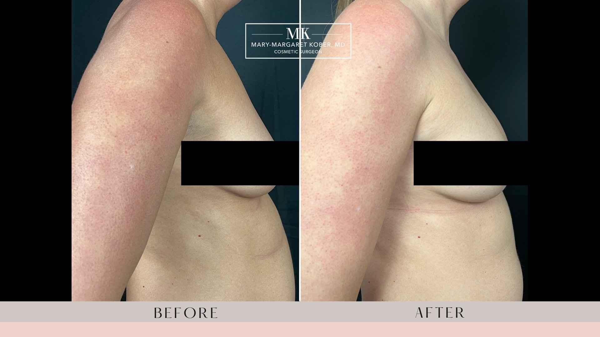 Jack Zamora MD Cosmetic Surgery and Aesthetics - Fat Transfer Breast