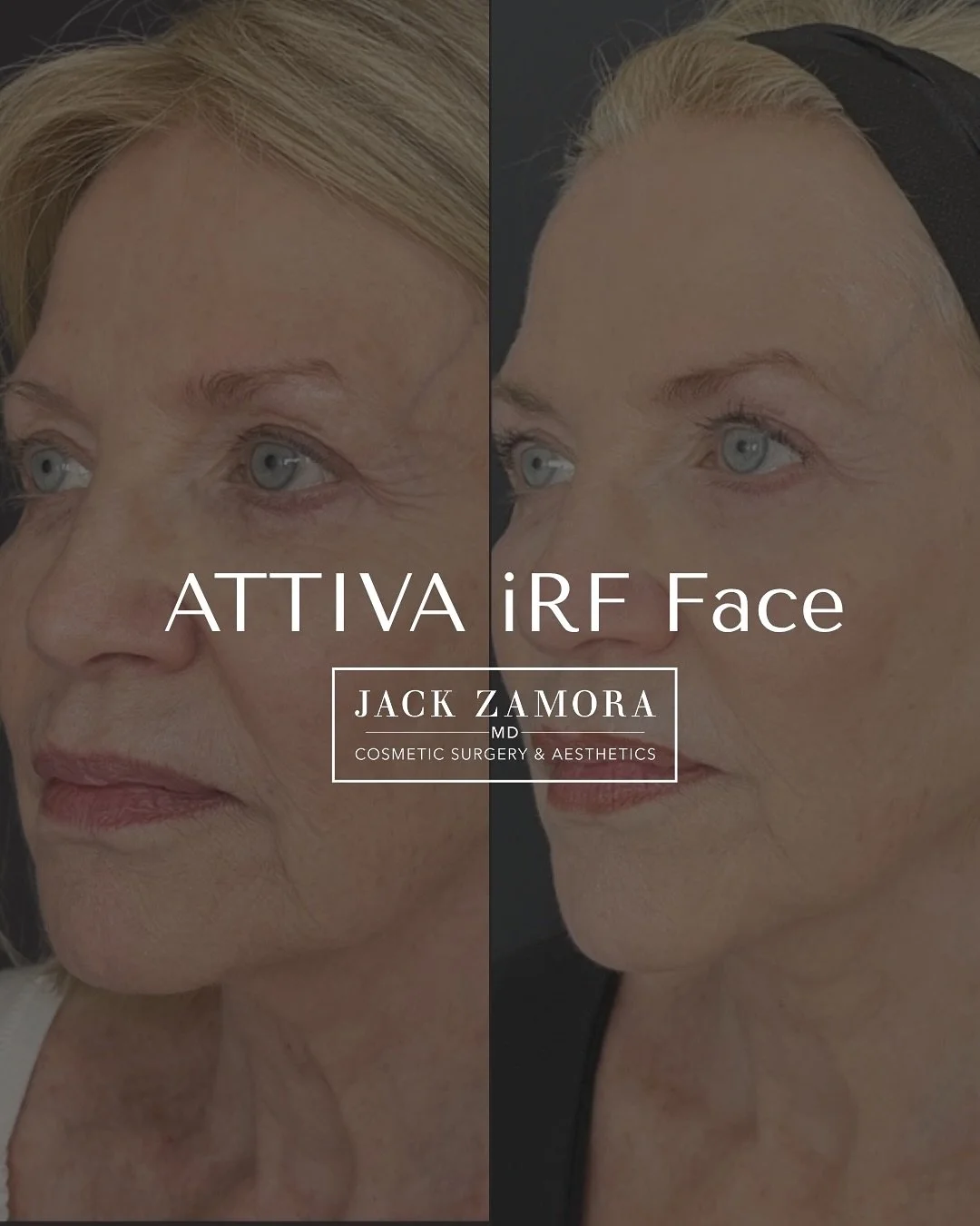 Subtle changes, stunning confidence ✨These results were achieved using ATTIVA iRF, a subdermal radiofrequency treatment that helps support collagen and improve the appearance of smooth, firm-looking skin - all with minimal social downtime. Using inte