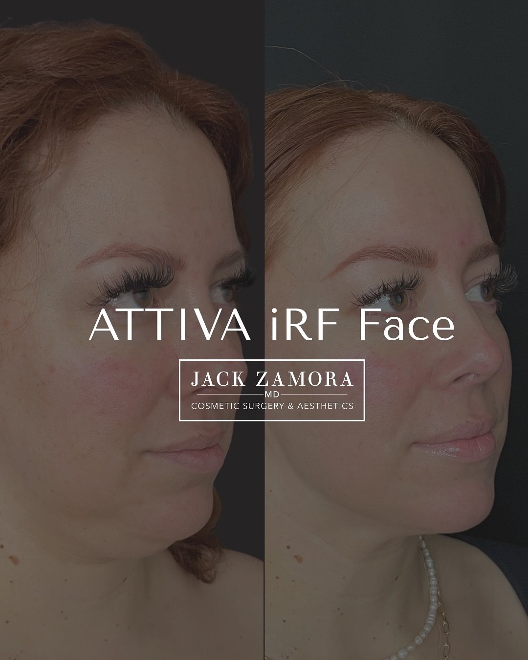 Lower face goals, 𝘢𝘤𝘩𝘪𝘦𝘷𝘦𝘥 ✨ This beautiful result comes from a combination approach: ATTIVA iRF for the lower face, chin lipo, and a suture lift. Together, they help refine contours and enhance definition with minimal downtime.
Always gratef