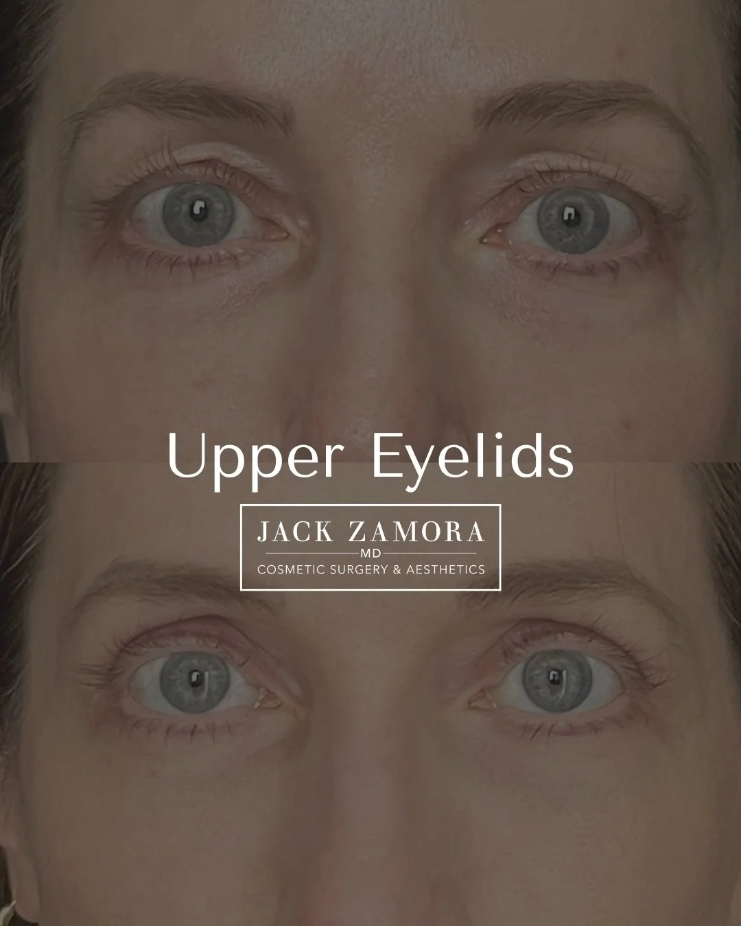 Upper eyelid blepharoplasty by Jack Zamora, MD✨

When excess skin settles along the upper lids, it can make the eyes look heavy or tired even when you feel anything but. The upper bleph addresses that directly by removing the excess skin and refining