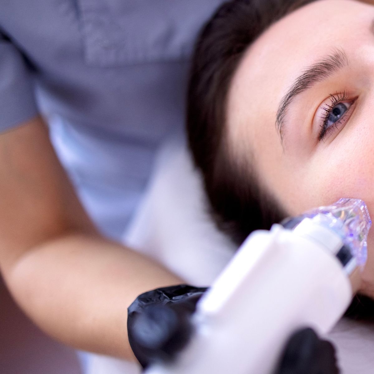 RF Microneedling Face