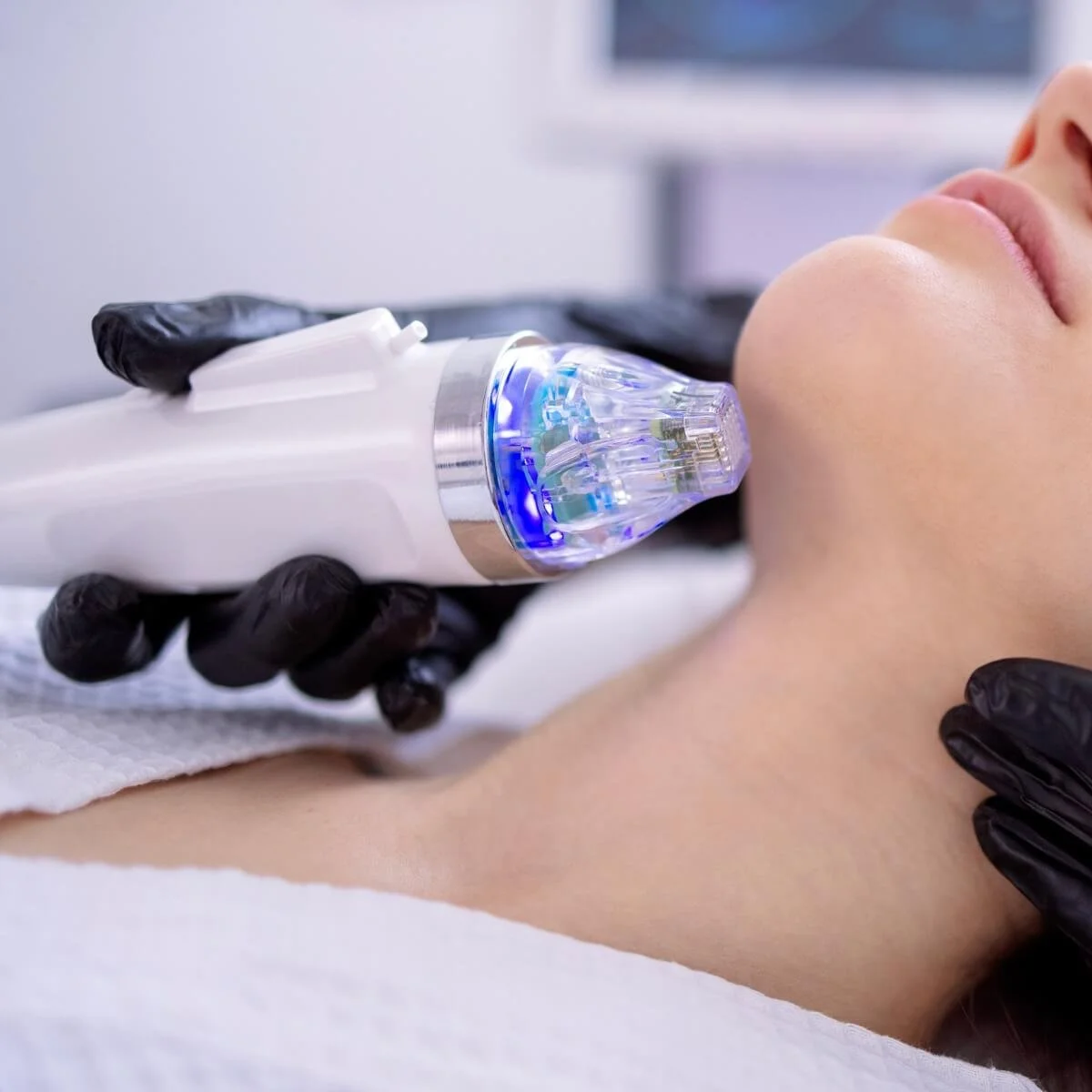 RF Microneedling Treatment to Neck