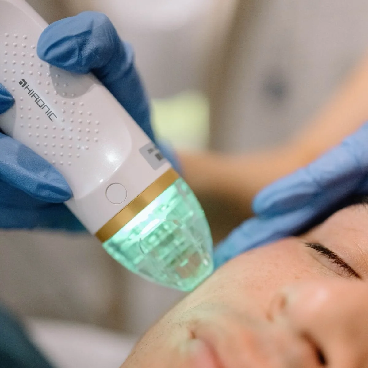 Radiofrequency Microneedling Treatment