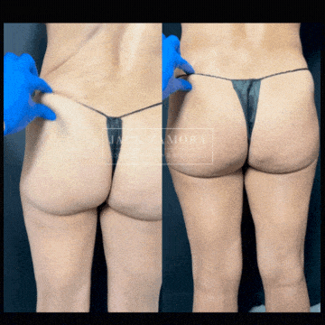 Before and after results of ATTIVA iRF Glutes