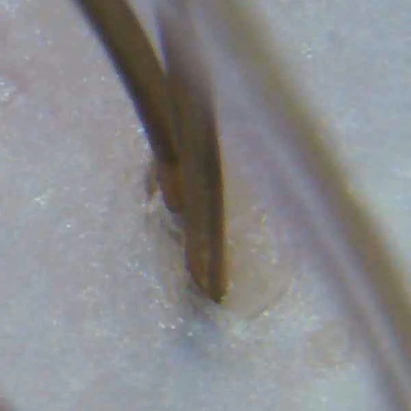 AFTER unclogged hair follicle