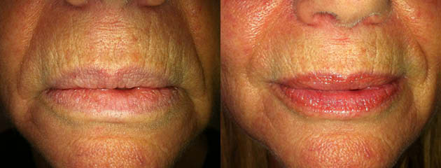  One month healed with Vaseline for gloss. Natural pigment lip stain. 