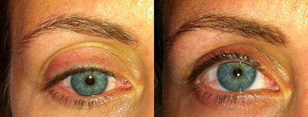Natural looking lash and brow enhancement. Healed at one month.