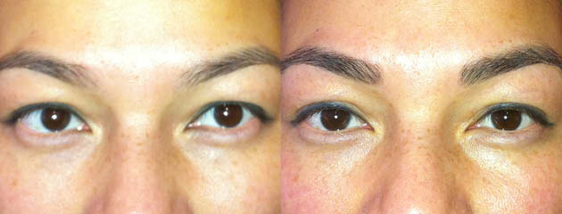  Brow enhancement. Healed at one month.&nbsp; 