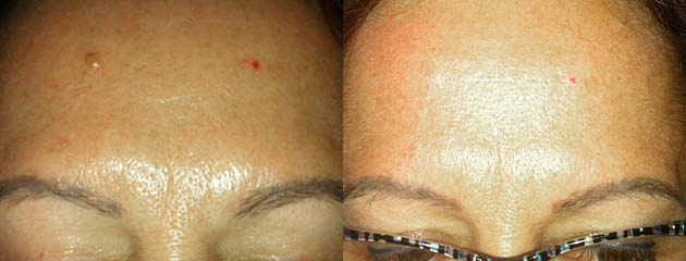  Mole removal on forehead.&nbsp;One month healed after one treatment. 