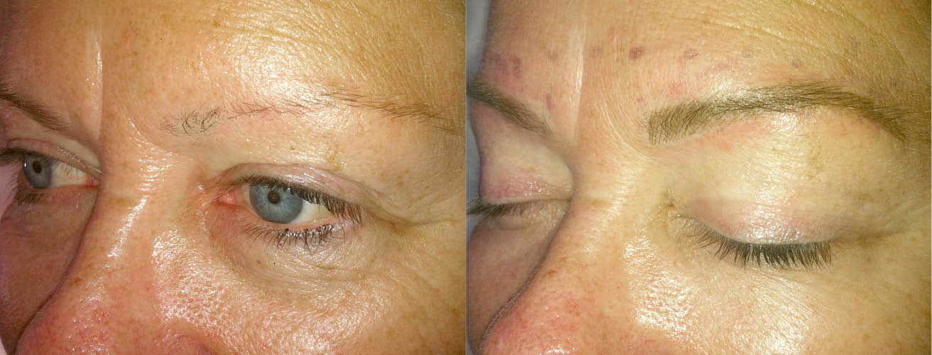 Blonde brow tattoo, immediately after treatment.