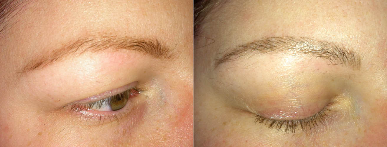 Eyebrow one month healed.