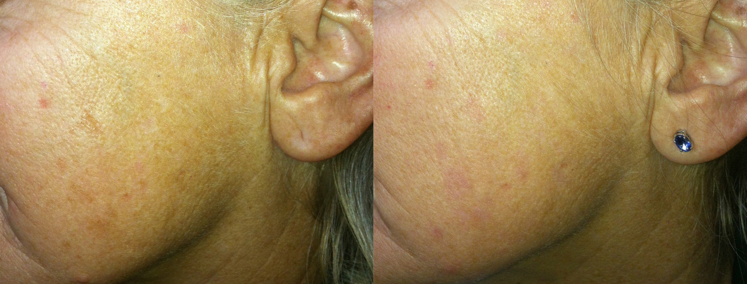  Small age spots removed, one month post treatment. 