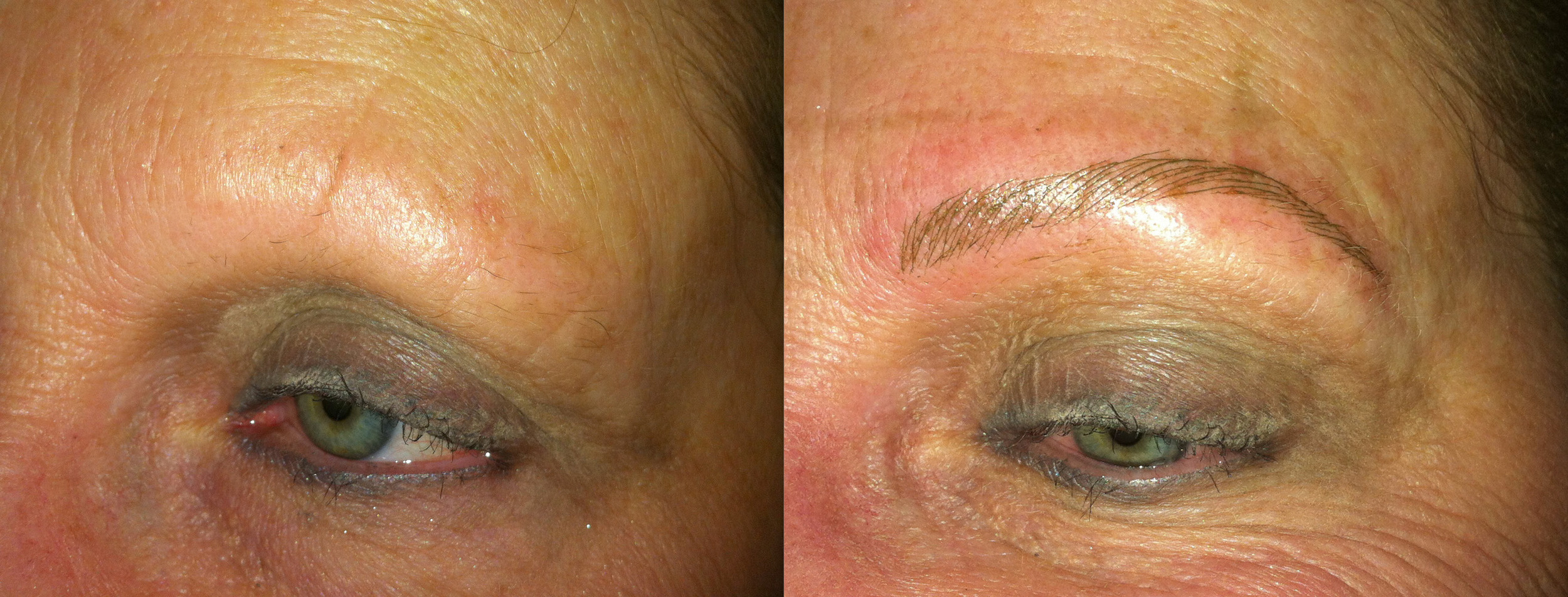  Alopecia client immediately after brow tattoo. 