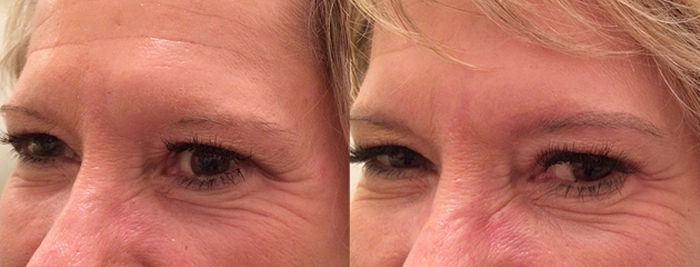 Healed after first treatment and six weeks post treatment.