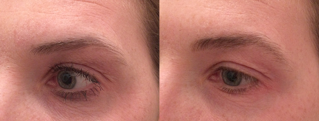  Soft and natural brow powder effect. Healed post one treatment at six weeks. 