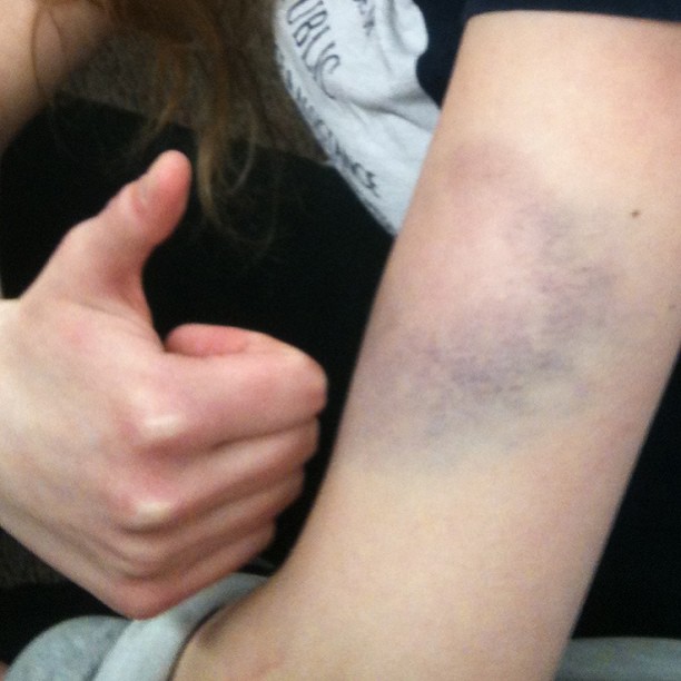 The aforementioned bruise. One day after