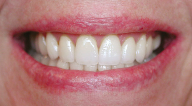 Cosmetic Dentistry After Photo