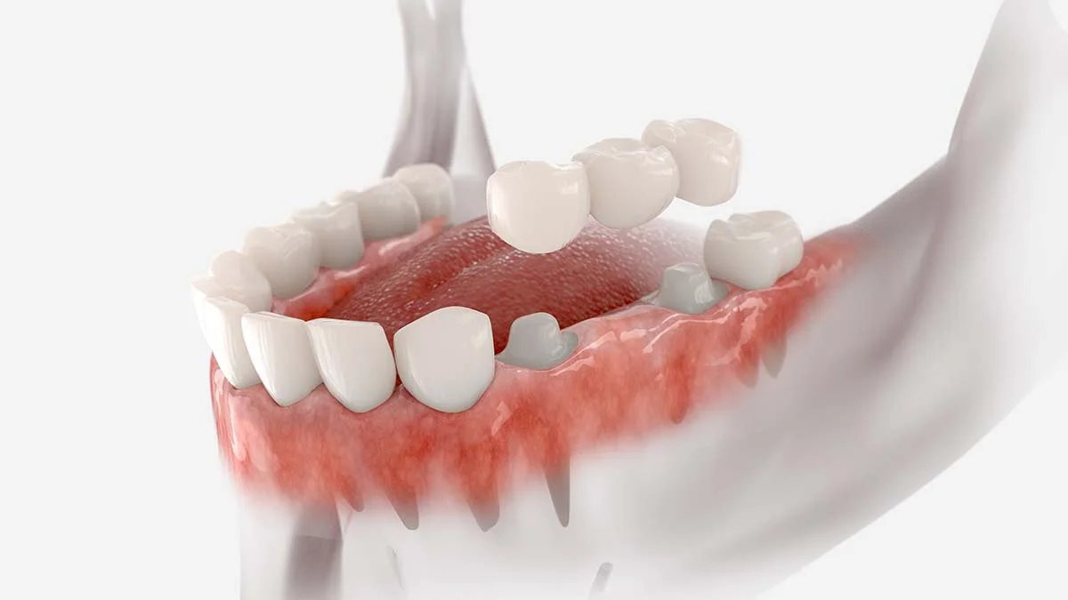 How Long Do Dental Bridges Last? Columbia Expert Guide