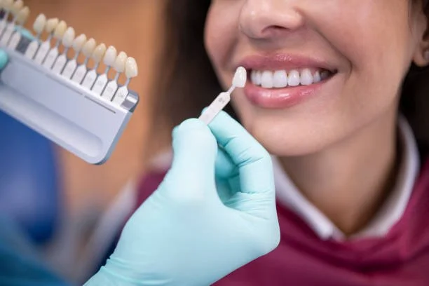 Veneers vs. Bonding: Columbia Expert Comparison