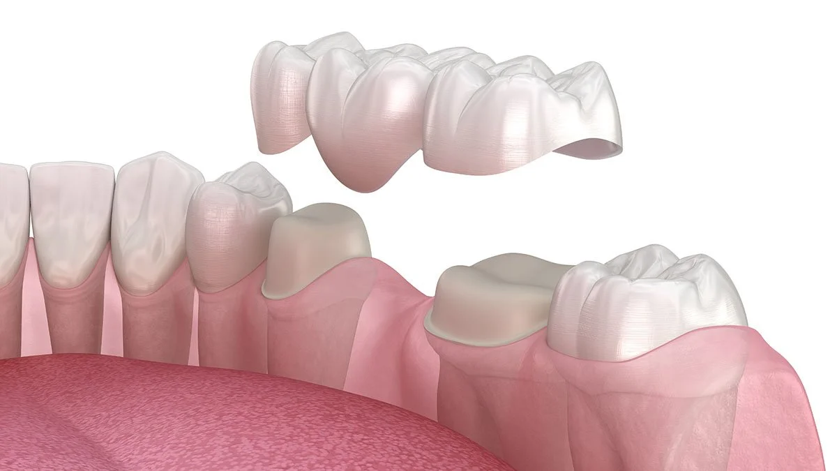 Who Is a Candidate for Dental Bridges in Columbia? Dentist’s Guide