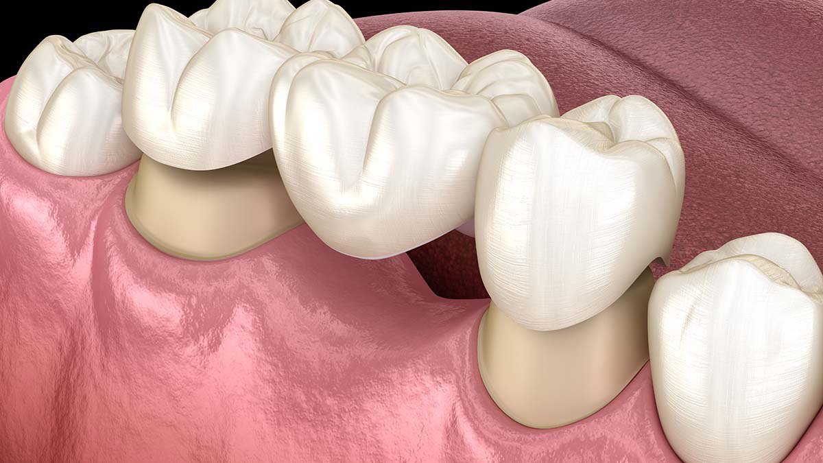 Problems with Dental Bridges: What Columbia Patients Should Watch For