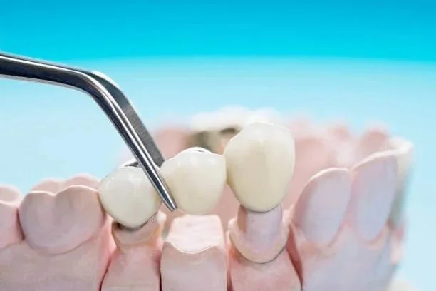 How to Care for a Dental Bridge in Columbia: Complete Guide