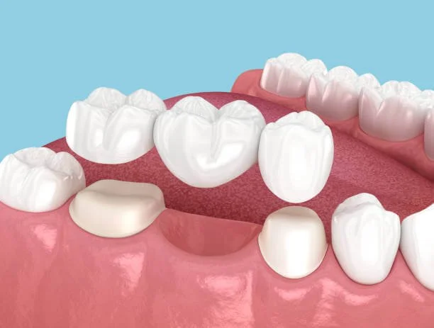 How Long Does It Take to Get a Dental Bridge in Columbia? Timeline Explained