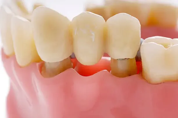 Replacing an Old Dental Bridge in Columbia: Options and What to Expect