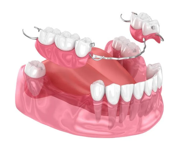 Dental Bridges vs. Partial Dentures in Columbia: Which Is Right for You?
