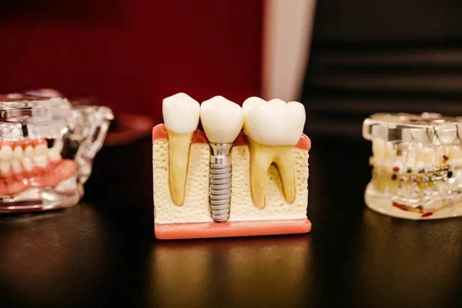 Are You a Candidate for Dental Implants in Columbia? Expert Guide