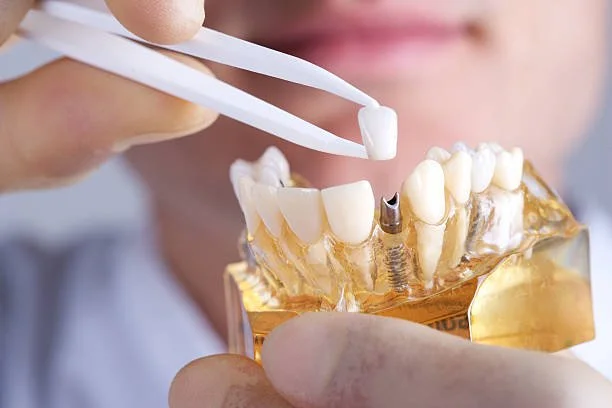 Understanding Dental Implant Costs in Columbia: Complete Guide