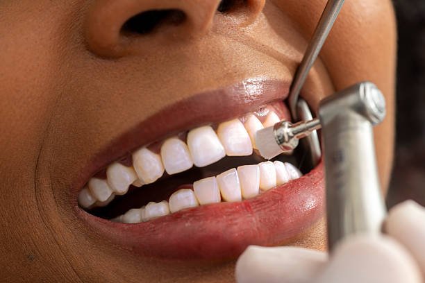 How Often Should You Get a Dental Cleaning in Columbia?
