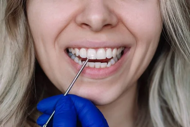 Fluoride Treatments in Columbia: Do Adults and Kids Really Need Them?