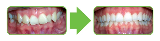 overbite-650.jpg