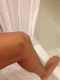 Self Acupuncture doesn't work