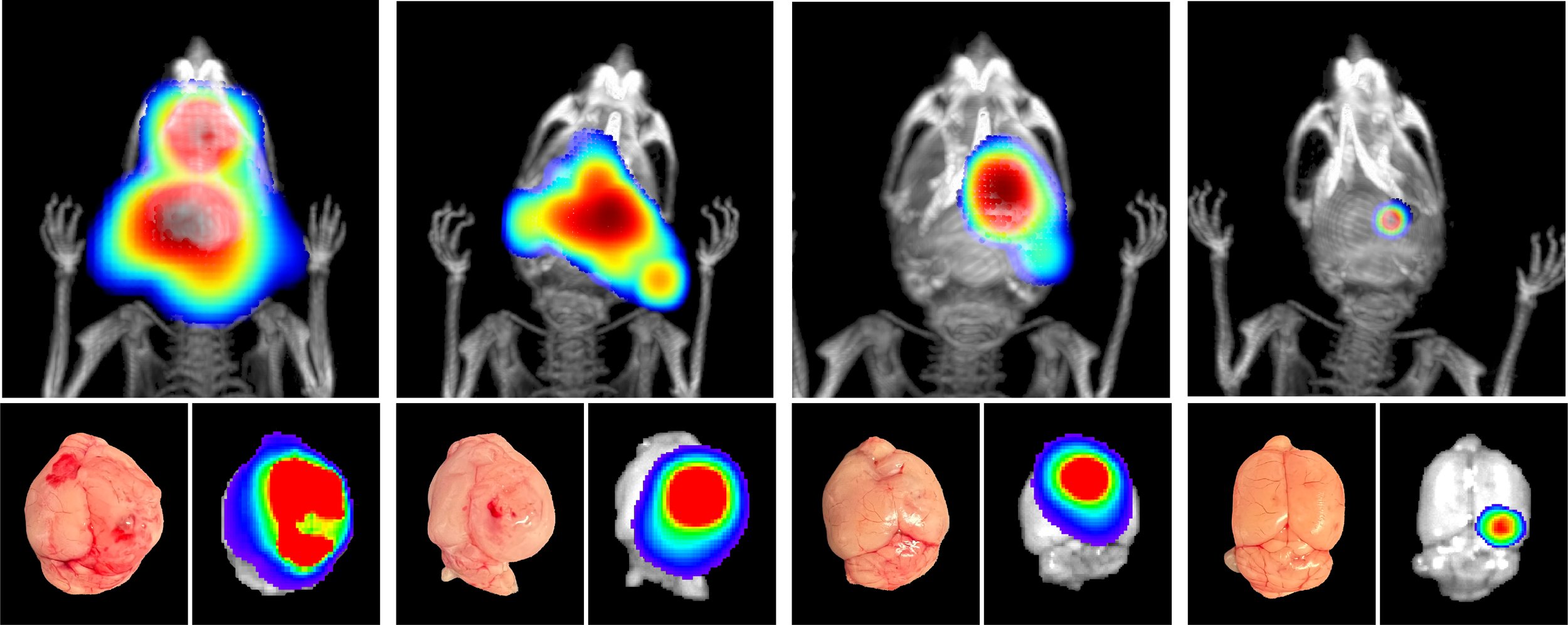 Brain tumor shrinks with ultrasound facilitated chemotherapy