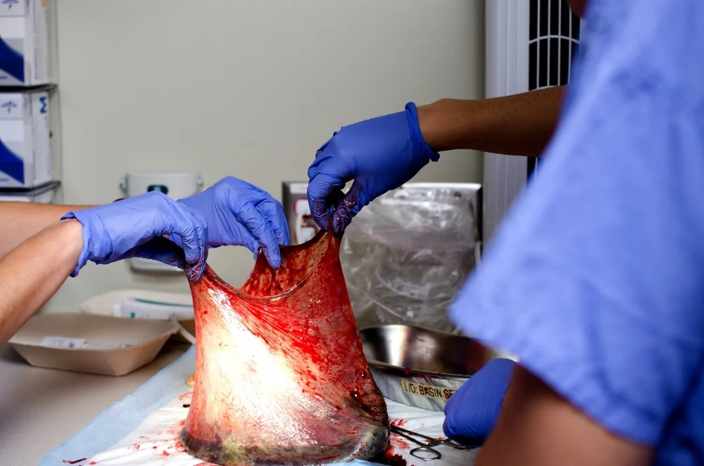 There are 2 layers to the Amniotic Sac, The Amnion and the Chorion.