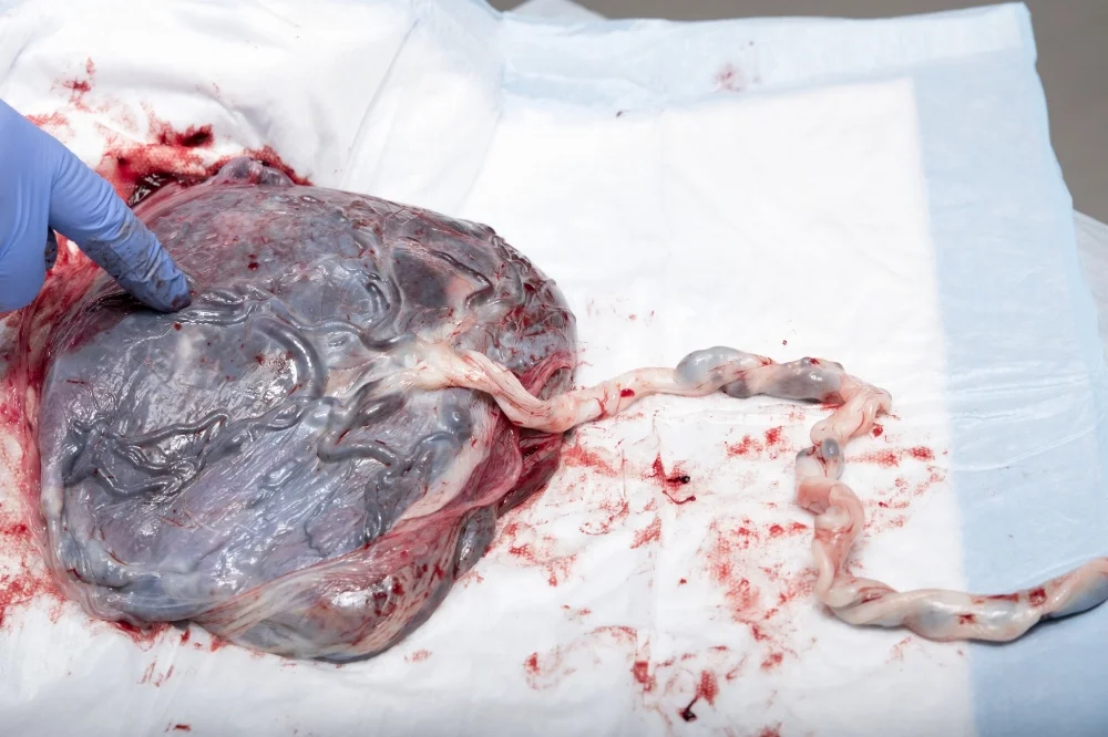 The Umbilical cord 2 arteries and 1 vein