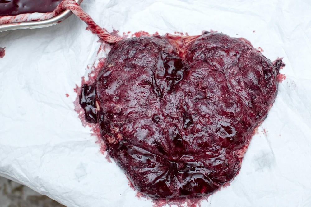 This is the mothers or maternal side of the organ. Notice the ridges and bumps, of this heart shaped organ. All is intact.