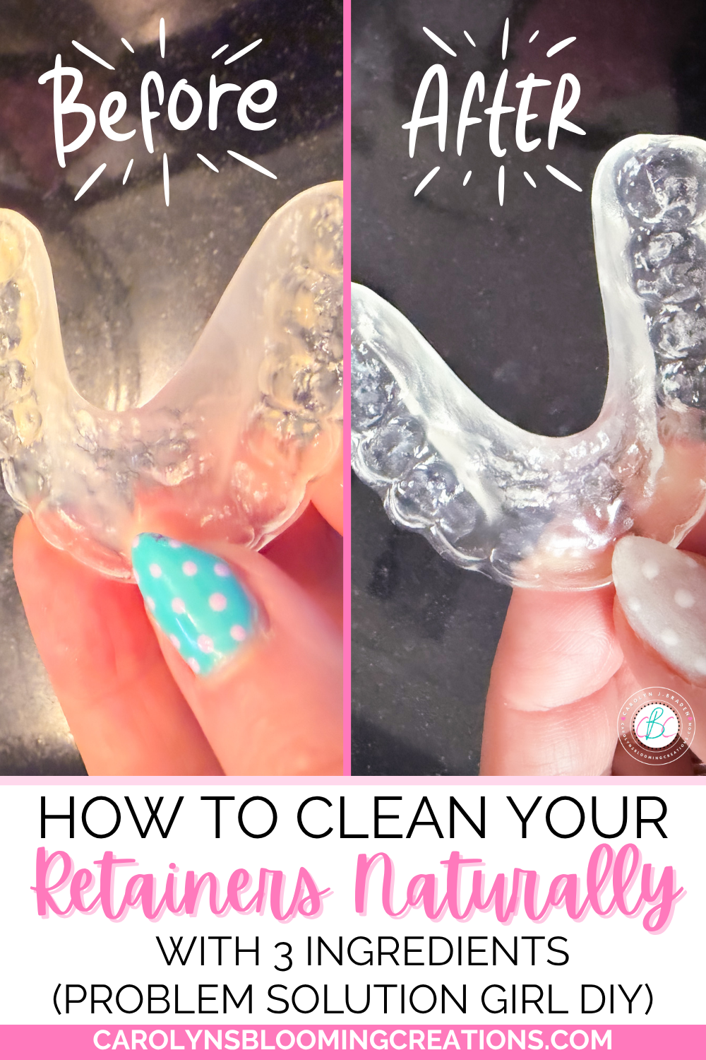 How to Clean Your Retainers Naturally with 3 Ingredients (Problem Solution Girl DIY)