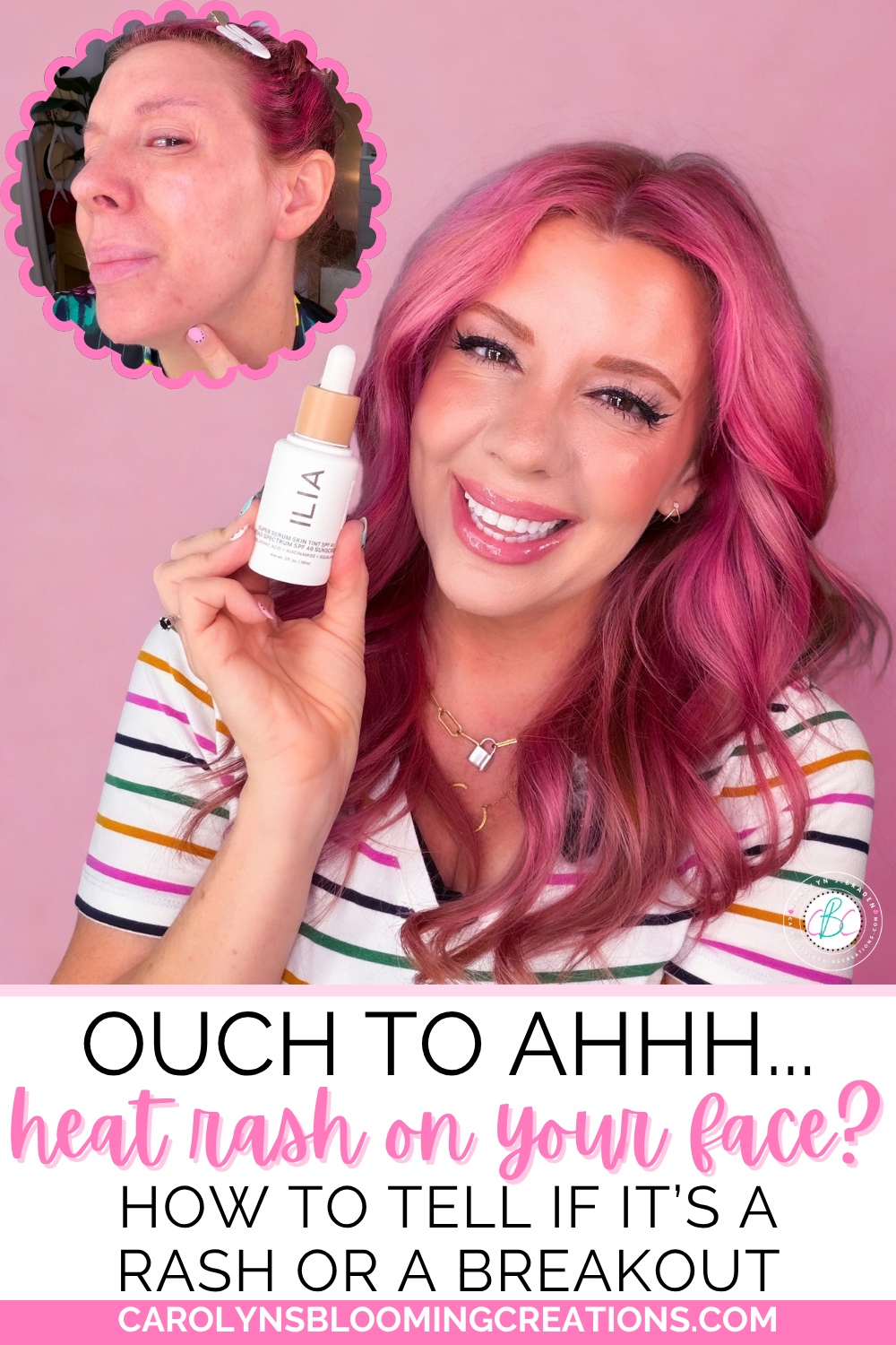 Heat Rash on Your Face? How to Tell If It’s Heat Rash or a Breakout