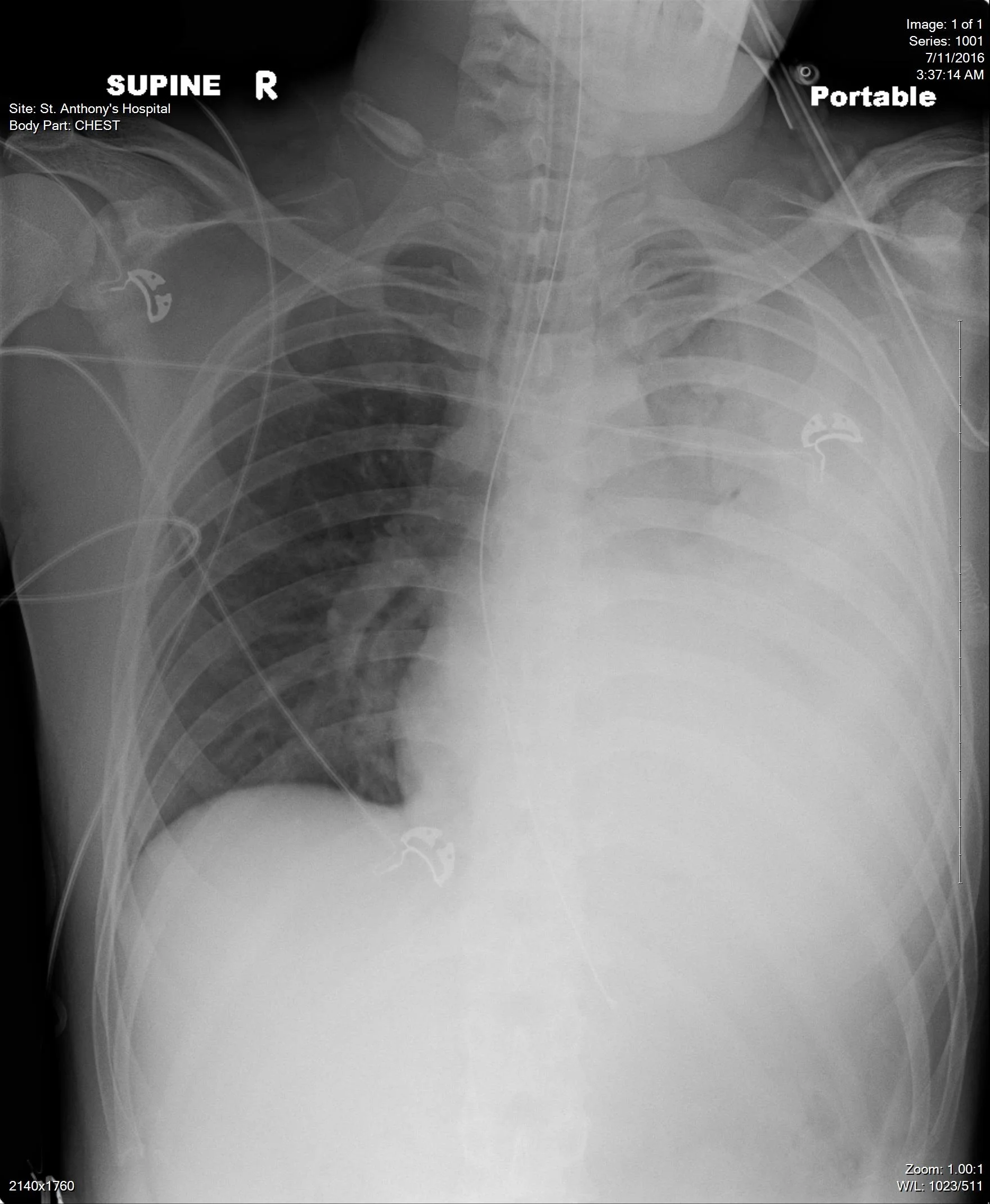 My first x-ray upon arrival at St. Anthony Hospital.