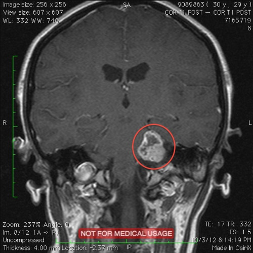 Brittany's MRI shows the tumor in the red circle.