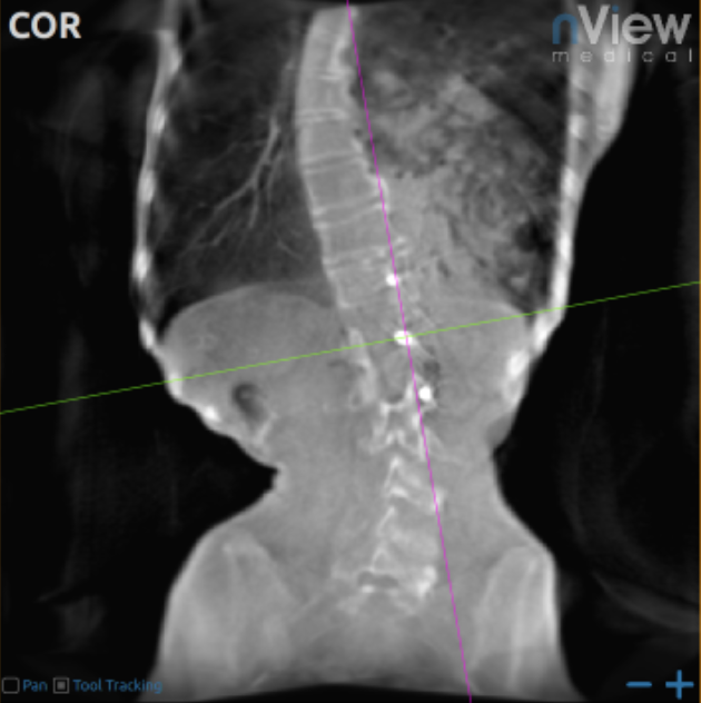 nView IMAGING OF THE LUNG - X-RAY SCATTER AND TOMOSYNTHESIS ARTIFACTS LIMIT CONTRAST IN THE LUNG
