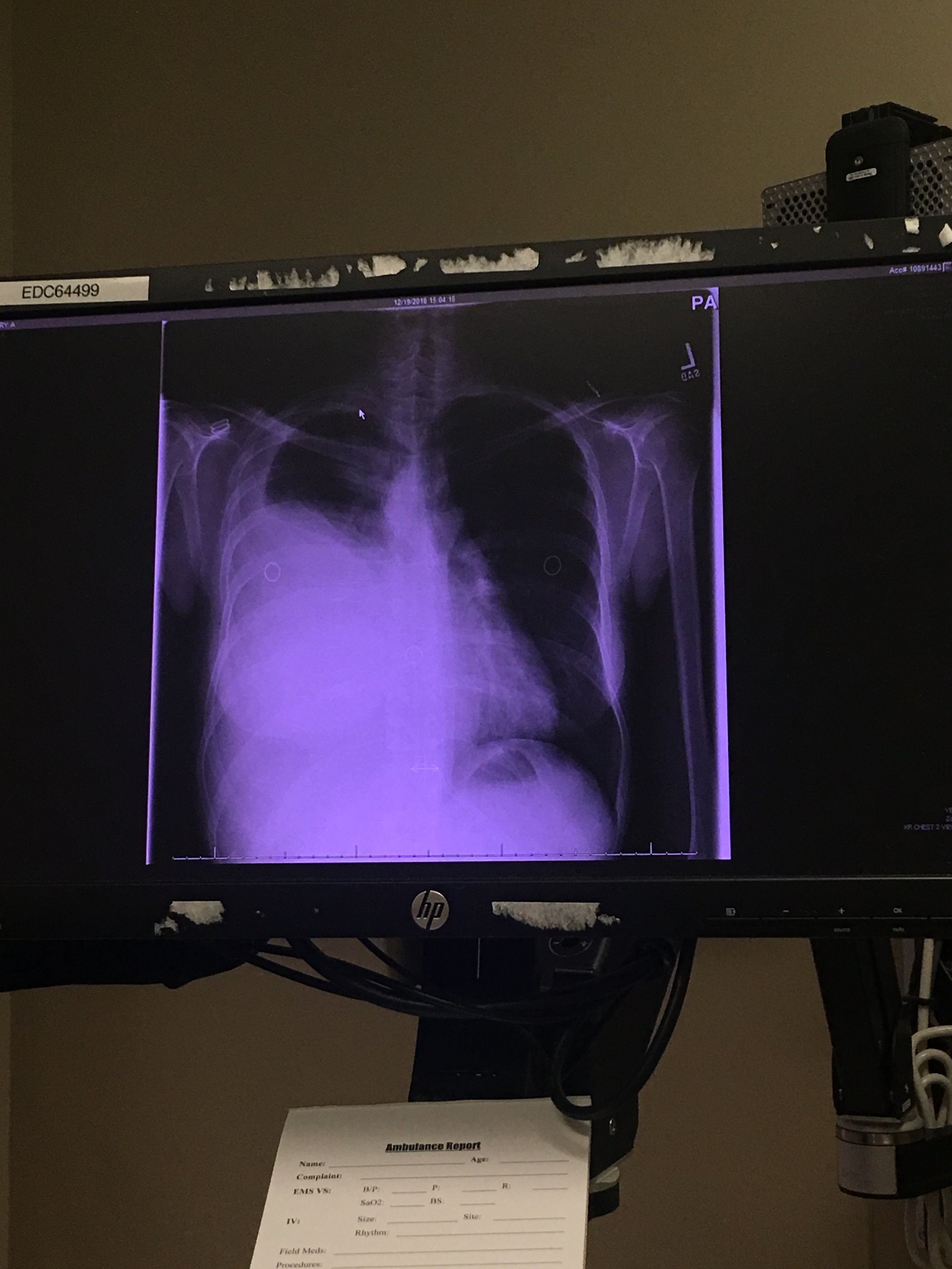 Recent X-ray of my lung - all the white on the left side (my right lung) is fluid complressing my lung. 