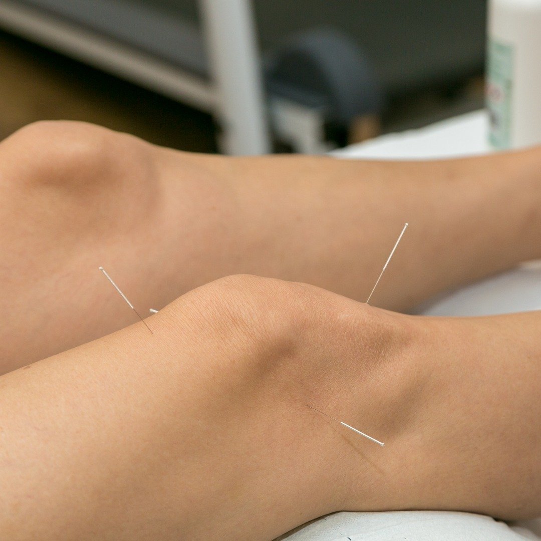 acupuncture-on-the-knee-treatment-of-osteoarthritis-in-the-knee.jpg