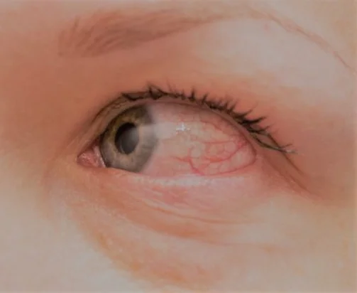 Tired of having Red, Itchy eyes?  You may benefit from allergy skin testing.